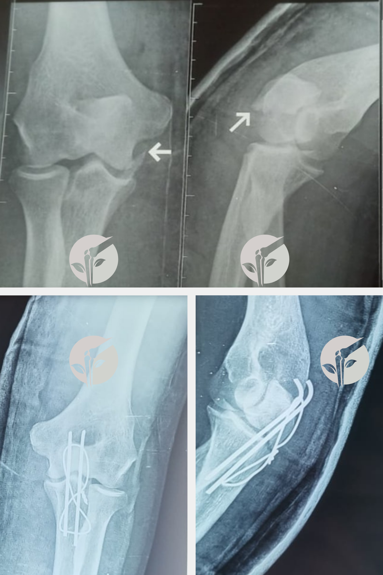 Fracture de l'olécrâne avec embrochage et haubanage par Dr. Bachiri Mohammed à Oujda